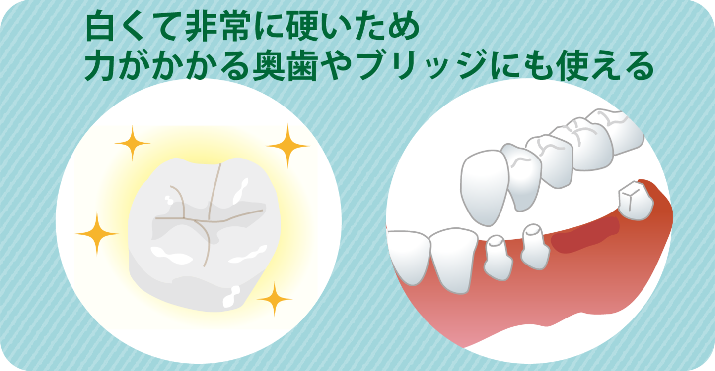 ブリッジに使えるジルコニア