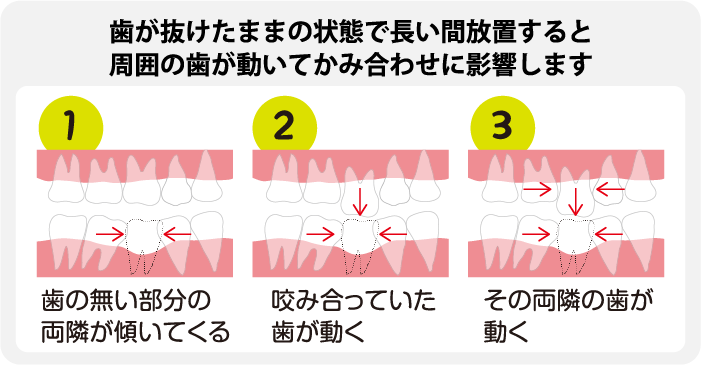 歯が抜けたまま放置するリスク