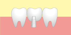 インプラント