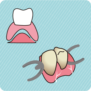 入れ歯が合わなくなる原因