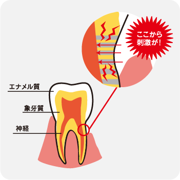 知覚過敏の原因