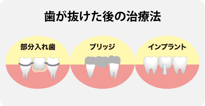 歯が抜けた後の治療法