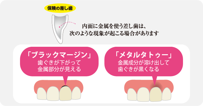 歯ぐきの変色する理由