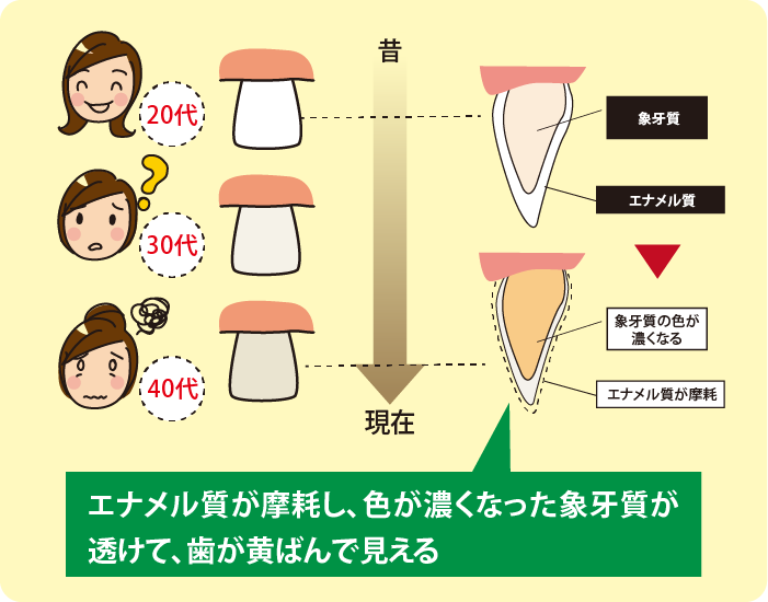 年齢とともに歯が変色して見える原因