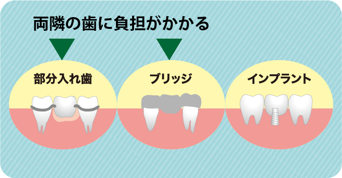 インプラントは周囲のへの負担がない