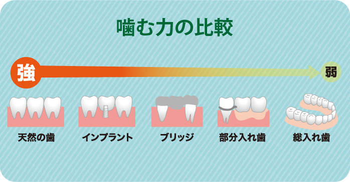 インプラントと入れ歯の噛む力の比較