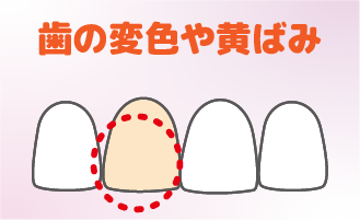 歯の変色や黄ばみ