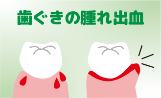 歯ぐきの腫れ出血