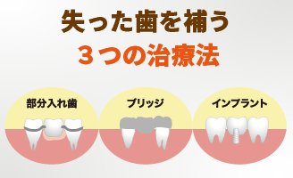 入れ歯・ブリッジ・インプラント、３つの治療法